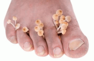 Запущенная форма грибка ногтя: лечение перекисью водорода